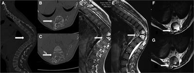 Surgical treatment of severe thoracic kyphosis and neurological deficit in a patient with Gorham–Stout syndrome: A case report and literature review